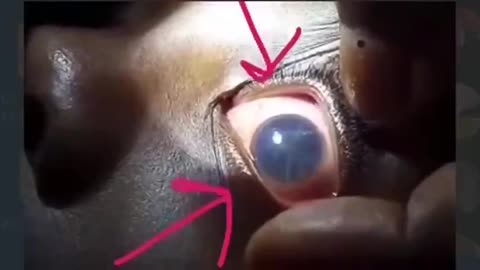 Dr. records Hydra Vulgaris swimming in the eye of an 11yr old vaxxed patient