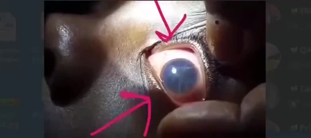 Dr. records Hydra Vulgaris swimming in the eye of an 11yr old vaxxed patient