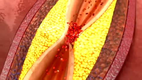 MYOCARDITIS & HEART ATTACK ANIMATION