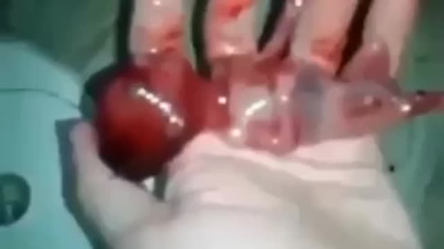 Abgetriebener Embryo