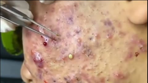 pimple popping satisfaction part 2