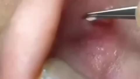 Satisfying Pimple Popping!