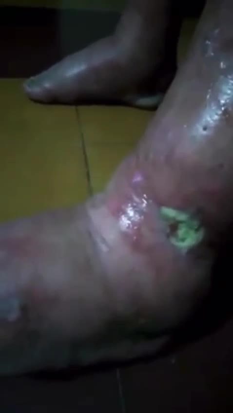 Absolutely hideous - A terrible reaction to the Pfizer ‘vaccine’