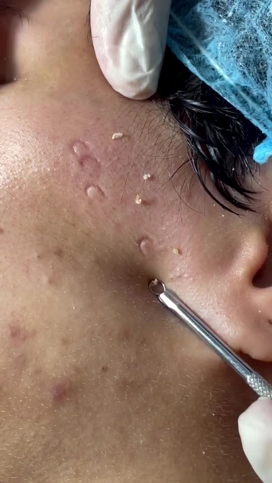 SATISFYING VIDEO!!! BLACKHEAD REMOVAL OF ACNE FACE.