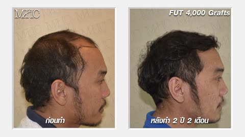 คลินิกปลูกผม MHC ปลูกผม ด้วยวิธี FUE FUT โดยแพทย์ผู้ชำนาญการ