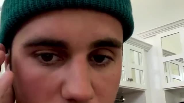 Justin Bieber has half his face paralyzed