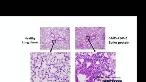 Dr. Cole -Vaccine is shredding lungs