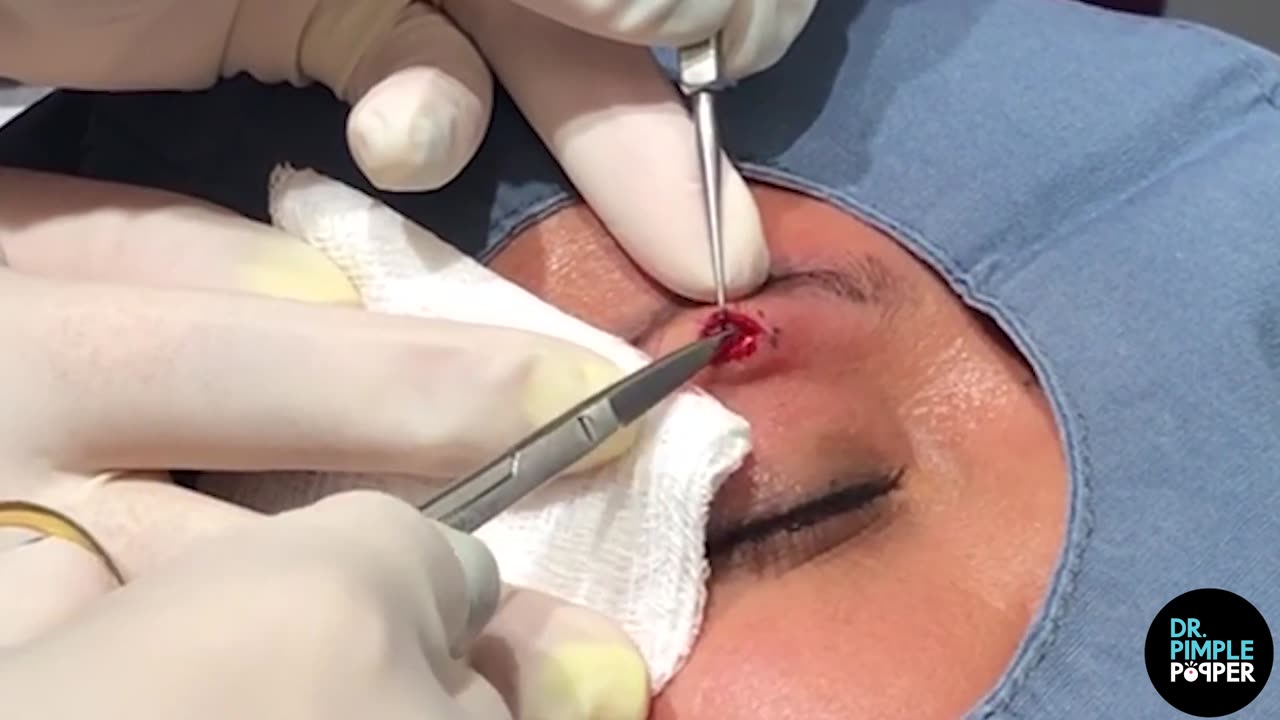 Aye! A Pilar Cyst on the Eye