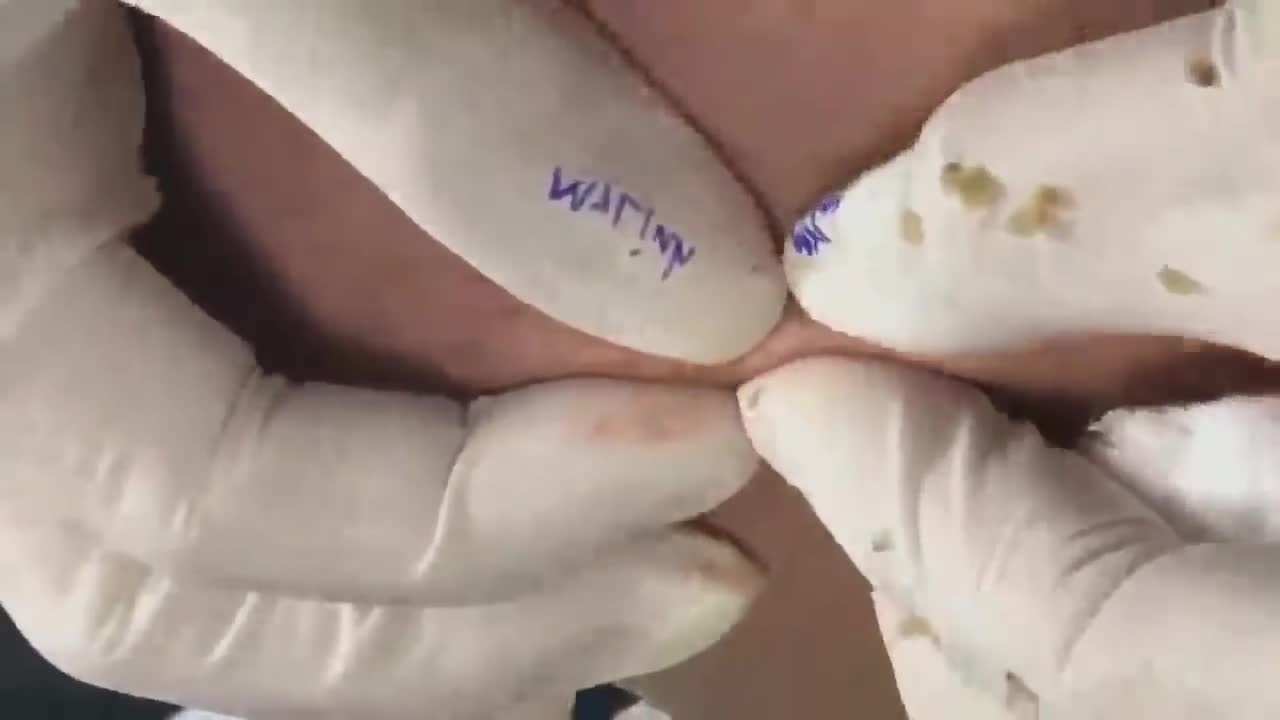 Satisfying acne removal