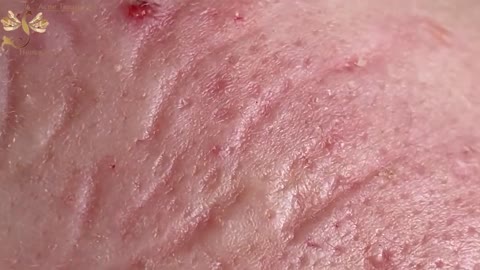 #170 | Acne Treatment Huong beauty