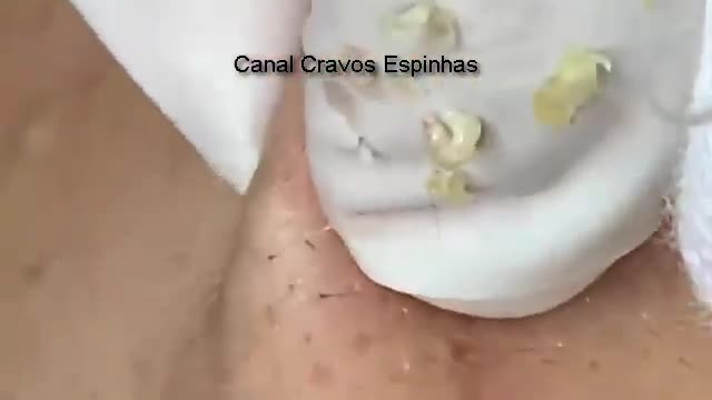 Squeezing Blackheads and Giant Pimples Removing Blackheads