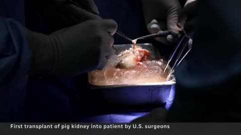 1st Pig Kidney Transplant