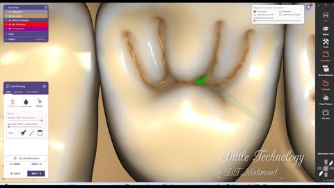 #design #naildesign #dental #dentaldesign #exocadexpert