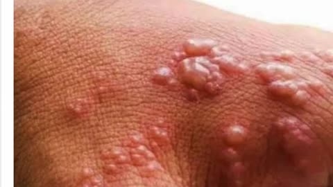 Nem majomhimlő, hanem oltáskárosodás