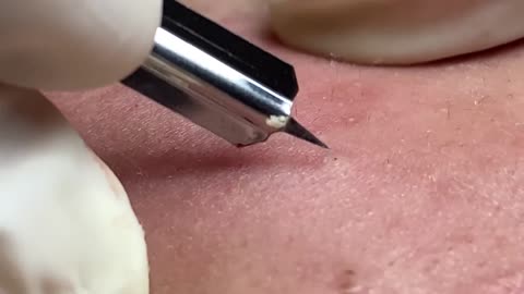 Acne Treatment Huong Da Nang# 021