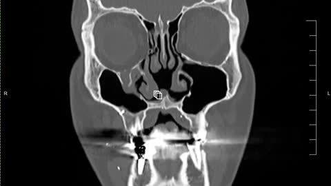 The inside of a damaged human skull