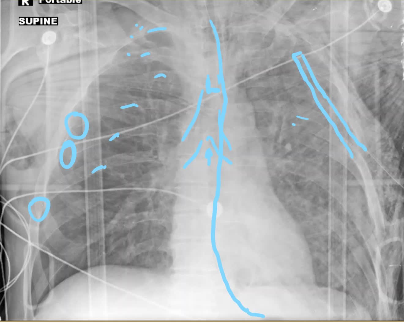 Trauma patient. CXR