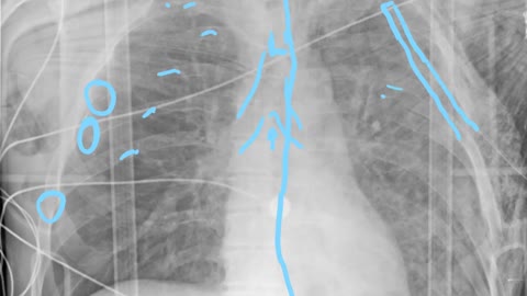 Trauma patient. CXR