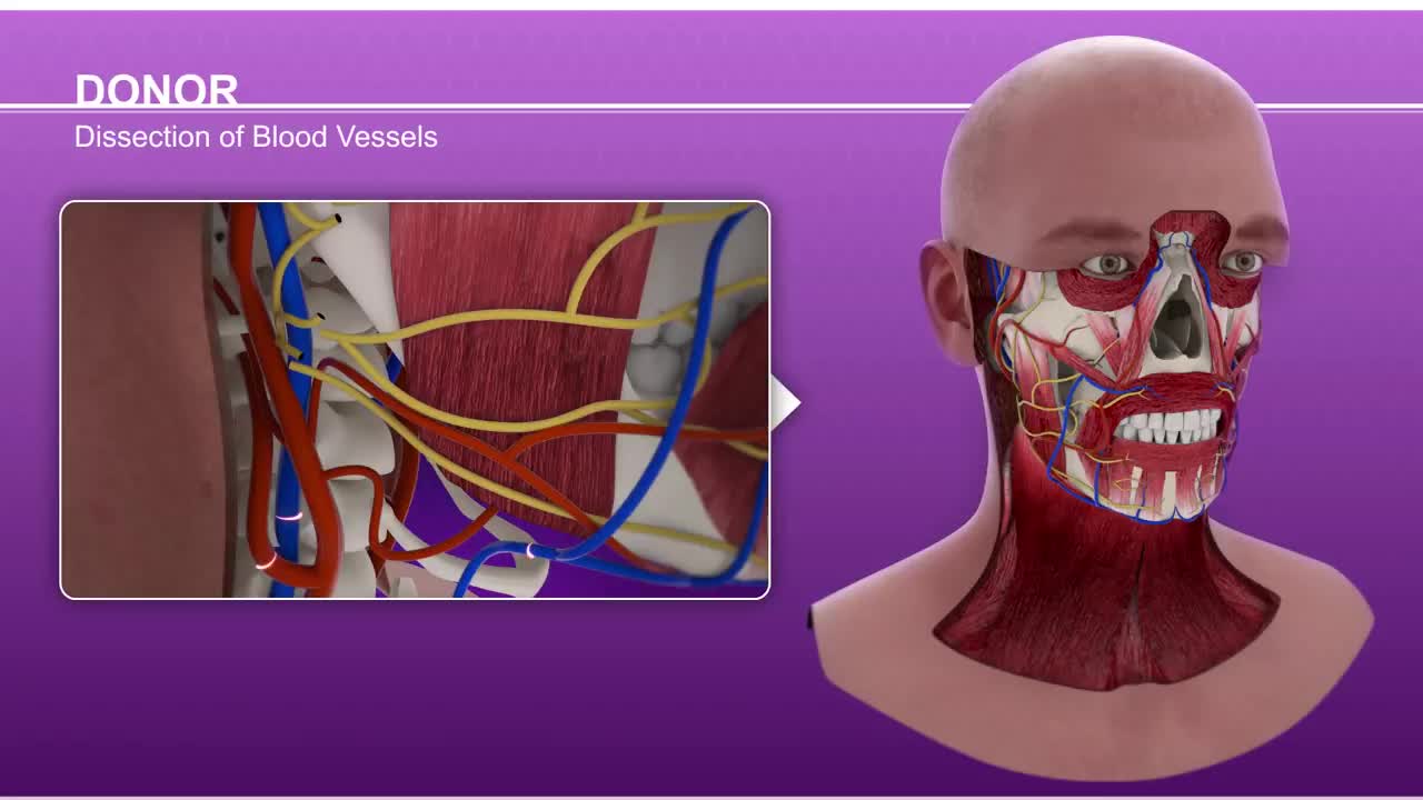 Cameron Underwood Face Transplant Surgical Animation