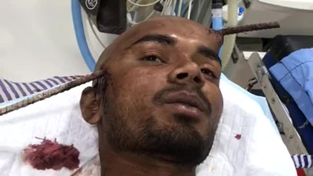 Man impaled by rod in head survives