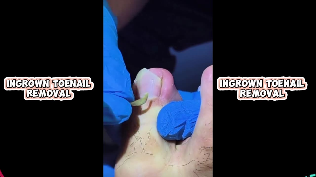 Satisfying ingrown toenail removal