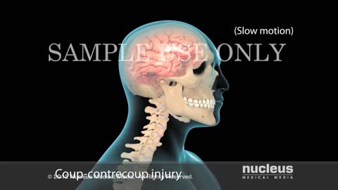 Concusion - What Happens To The Brain