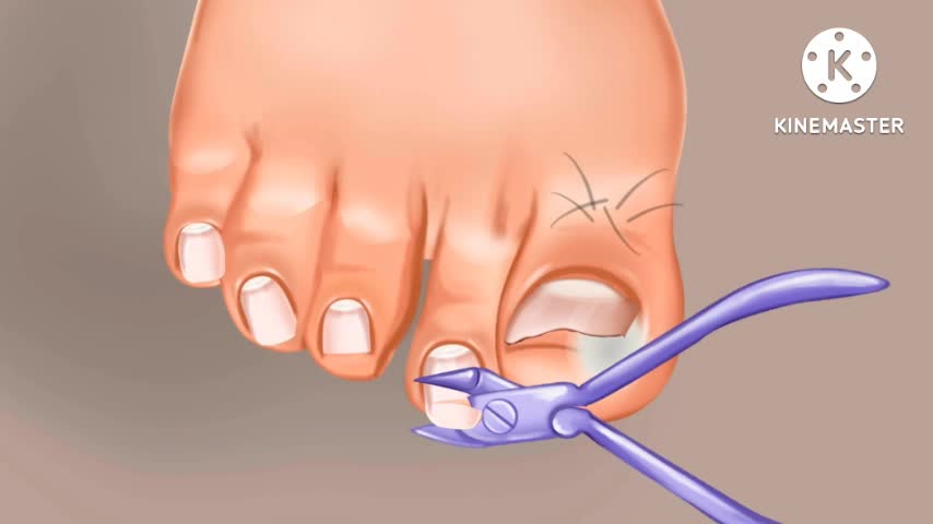 Ingrown toenail , cut damaged toenail carefully