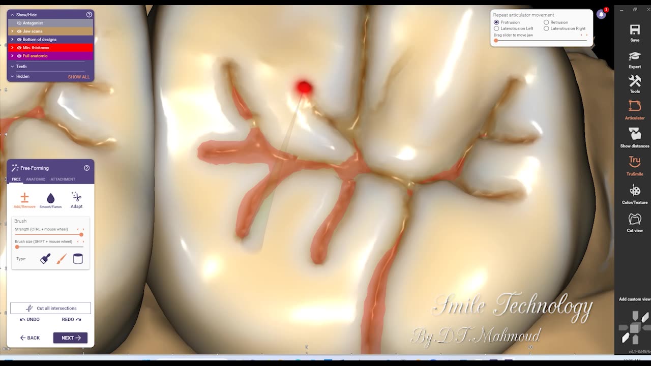 #design #naildesign #dental #dentaldesign #exocadexpert