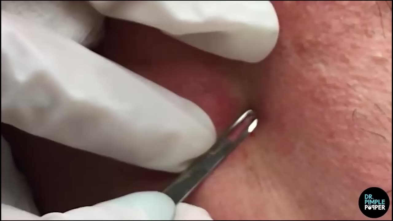 50 Minutes of Blackheads! Clusters of Blackheads with Dr. Pimple Popper