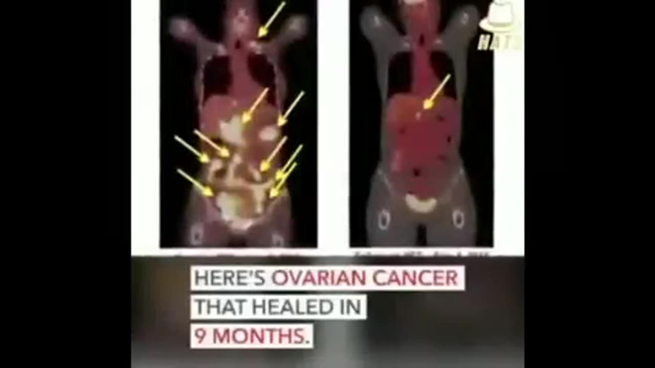 A Cure For Cancer Discovered Over 40 Years Ago That The FDA Is Still Fighting!?