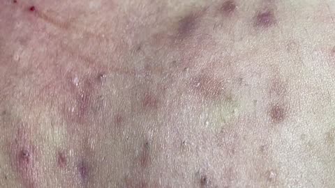 Big Blackheads Acne Removal | Acne Treatment (#4)