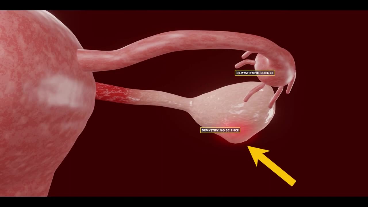 Ovarian Torsion - Twist In Female Ovaries