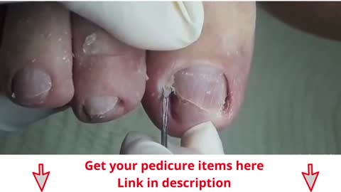 Use of scalpel nº 15 and gouge in ingrown toenail