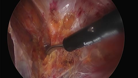 Laparoscopic Reduction of Strangulated Right Inguinal Hernia; Part I