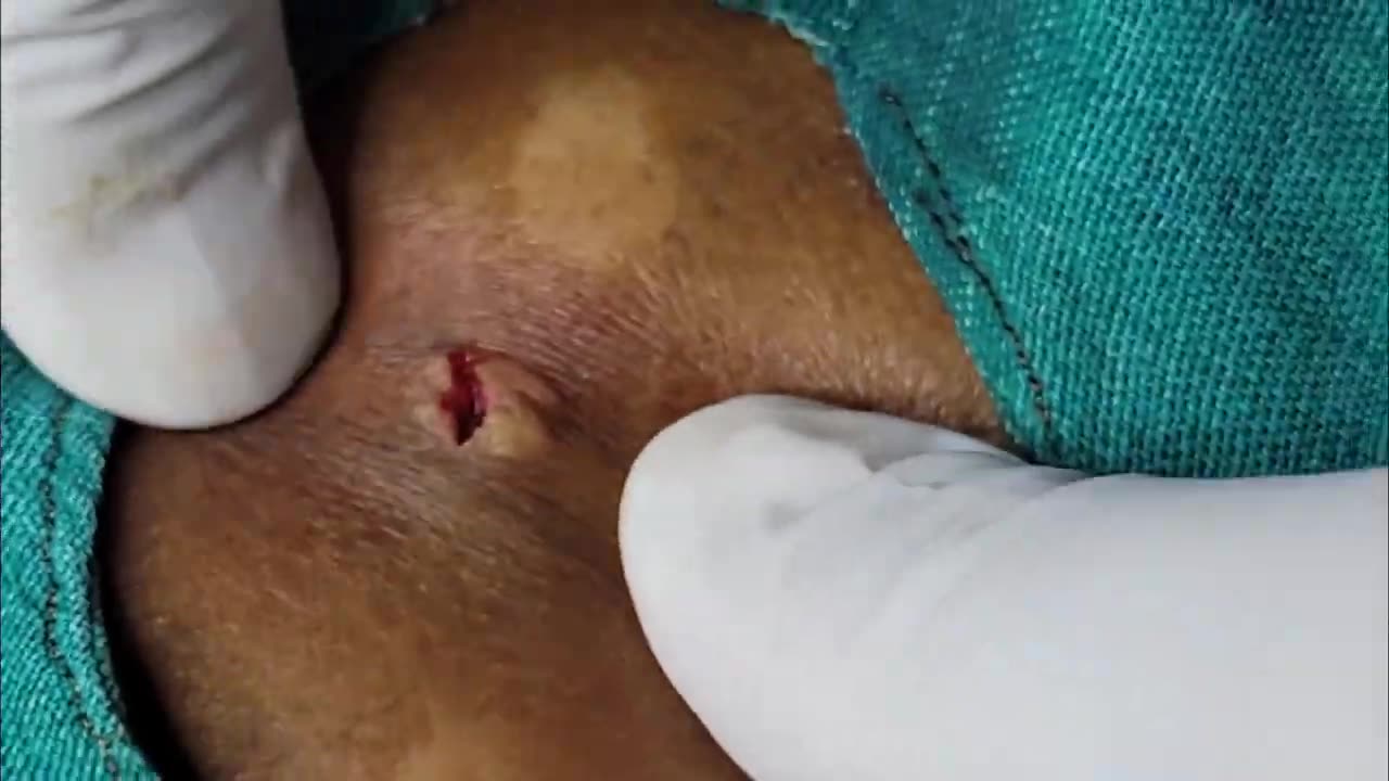 Relax your mind with popping of this creamy Cyst