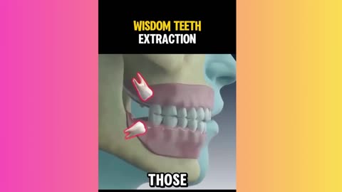 How wisdom teeth are extracted… 😳🦷