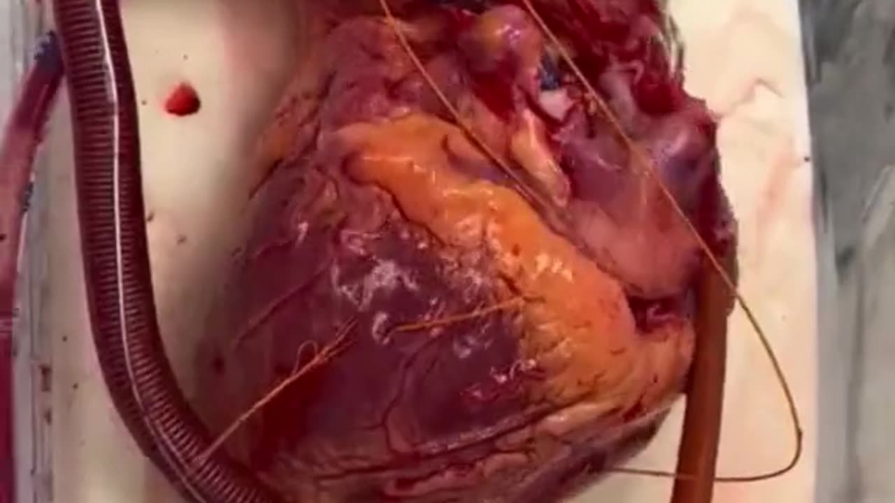 A Human Heart Awaiting Transplant