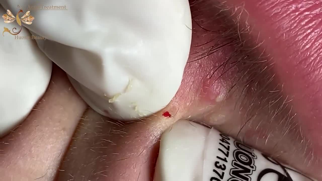 # 221 | Acne Treatment Huong beauty