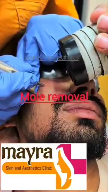 Effective Mole Removal Treatment: Safe Solutions for Clearer Skin