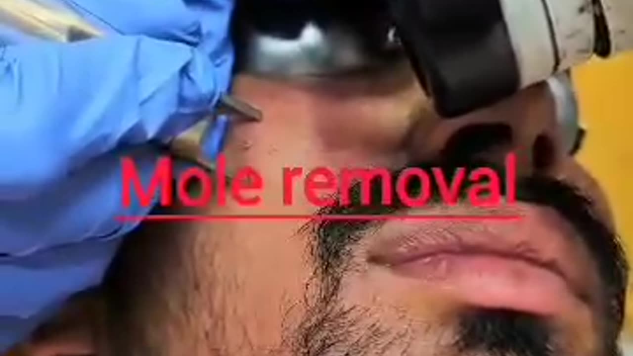 Effective Mole Removal Treatment: Safe Solutions for Clearer Skin