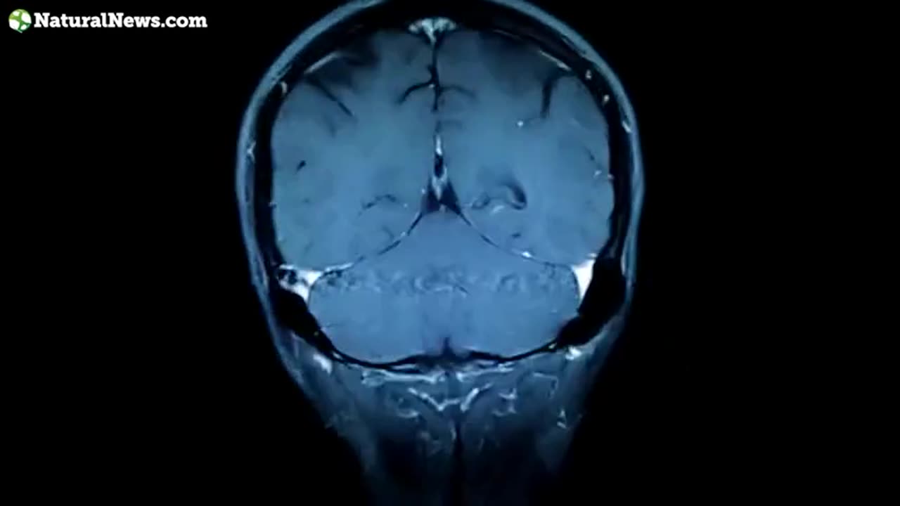 THIS IS WHAT THE HUMAN BRAIN LOOKS LIKE UNDER STRESS