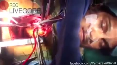 He woke up during open heart surgery