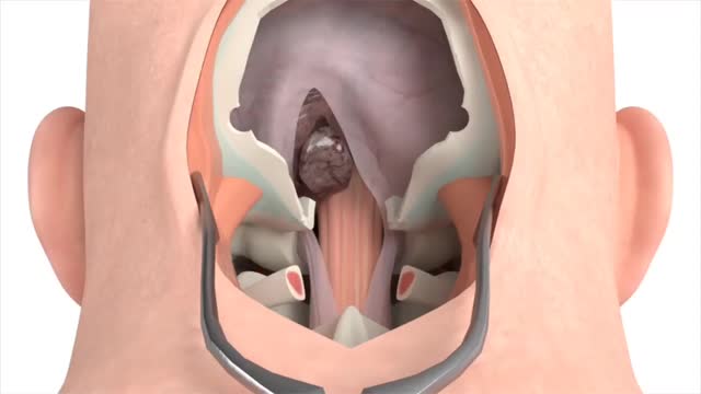 Craniectomy surgical procedure - 3D animation