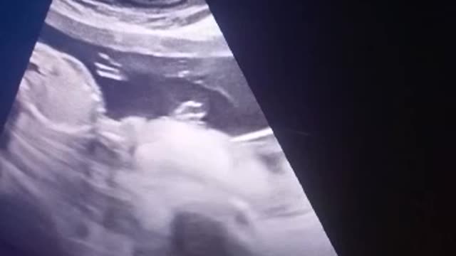 Moving baby video inside the womb