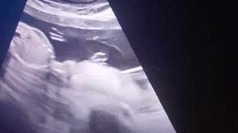 Moving baby video inside the womb