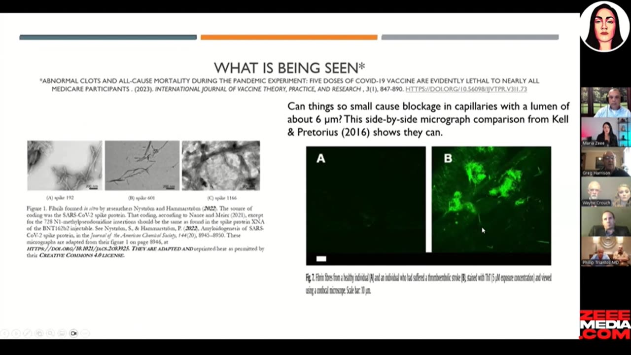 Micro Clots Found in Covid-Injected Stroke Victims Are Amyloid Proteins