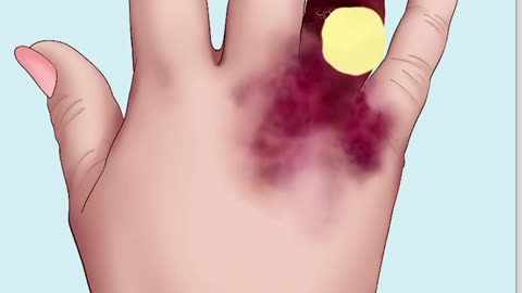 ASMR Treatment Maggot infested fingers 🤞
