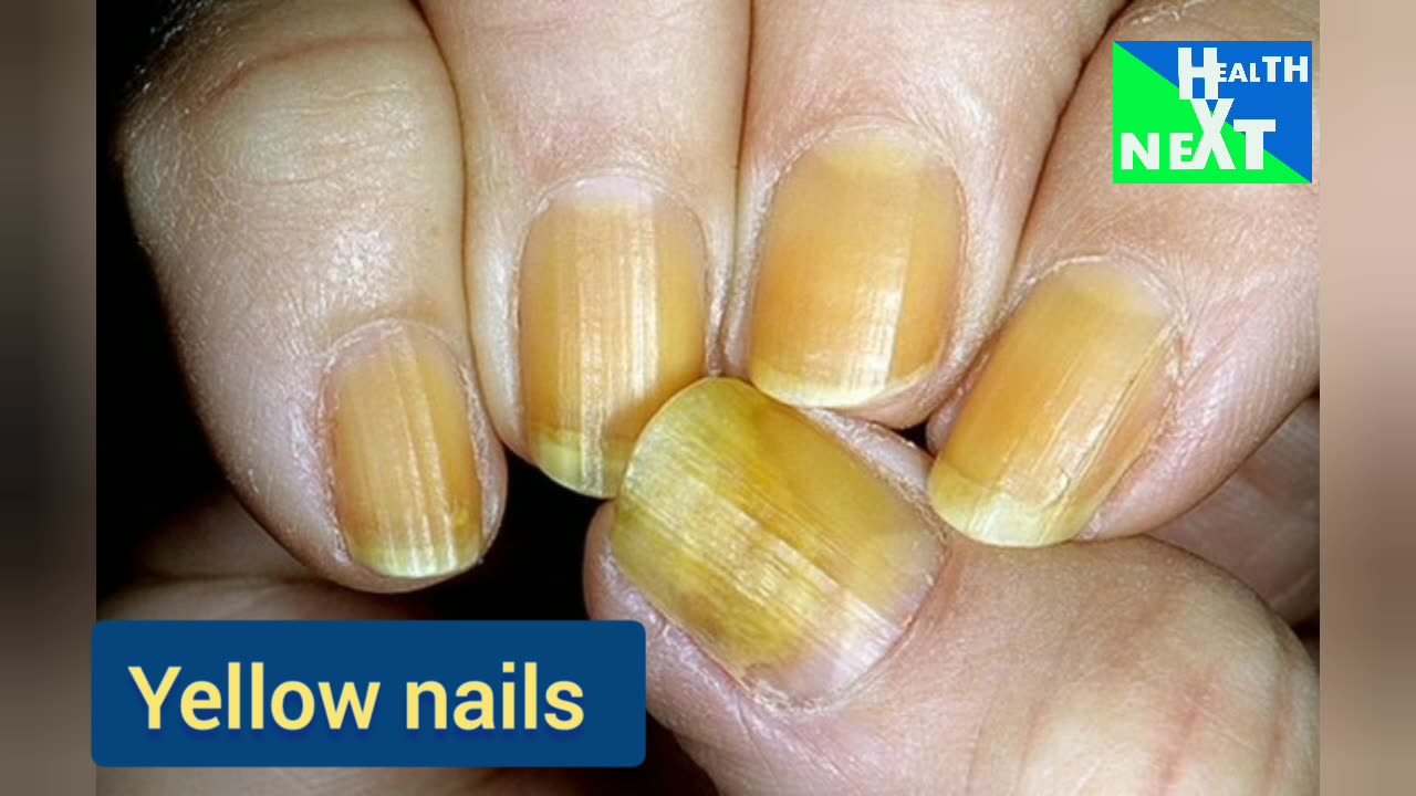 Yellow nails made me uncomfortable but I realized the cause,all in this video.