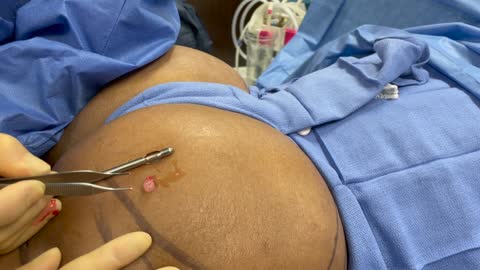 Ultrasound Guided VASER Assisted Silicone Removal from the Buttocks | PLASTIC SURGERY PROCEDURE