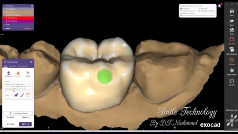 #design #naildesign #dental #dentaldesign #exocadexpert